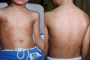 Вакцинация – единственное эффективное средство, предупреждающее заражение корью