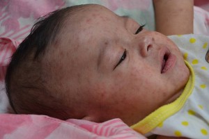 Корь не отступает: в Алматы нестабильная эпидемситуация