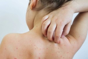 Врачи бьют тревогу: в Алматы нестабильная ситуация по заболеваемости корью