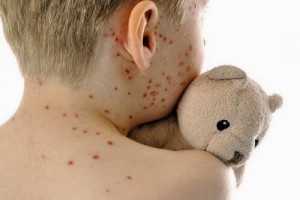 
                    В Алматы наблюдается вспышка кори у детей
                