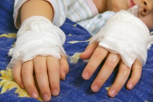 В Шымкенте получивший тяжелые ожоги 10-летний мальчик перенес 19 операций