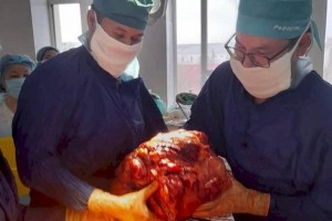 Врачи-онкологи удалили у жителя Атырау опухоль весом 15 килограммов