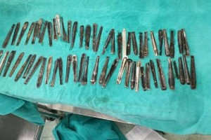 Более 60 ручек от ложек обнаружили врачи в желудке мужчины
