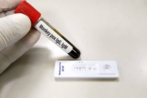 
                    В Нидерландах впервые ребенок заразился оспой обезьян
                