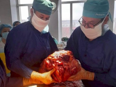 
                    Врачи-онкологи удалили у жителя Атырау опухоль весом 15 килограммов
                