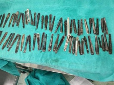 
                    Более 60 ручек от ложек обнаружили врачи в желудке мужчины
                