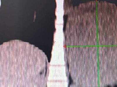 
                    Онкологи Алматы удалили 20-сантиметровую опухоль у молодой пациентки 
                