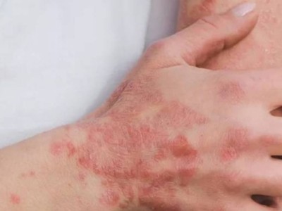 
                    Казахстанцы могут бесплатно получить инновационное лечение псориаза
                